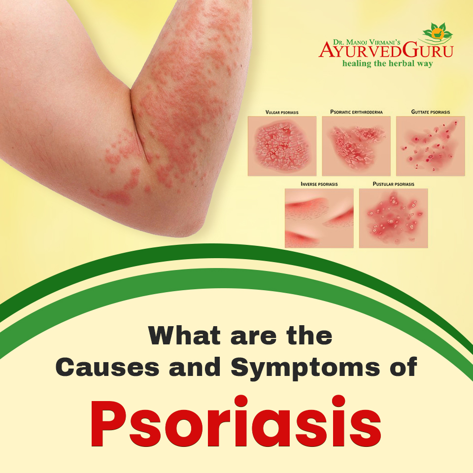 What Are The Causes And Symptoms Of Psoriasis Ayurved Guru